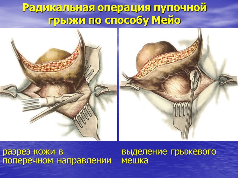 Радикальная операция пупочной грыжи по способу Мейо  разрез кожи в  поперечном направлении